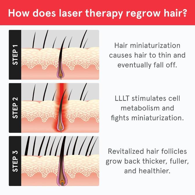 Laser Hair Growth System FDA Cleared Hair Loss Treatment for Men and Women