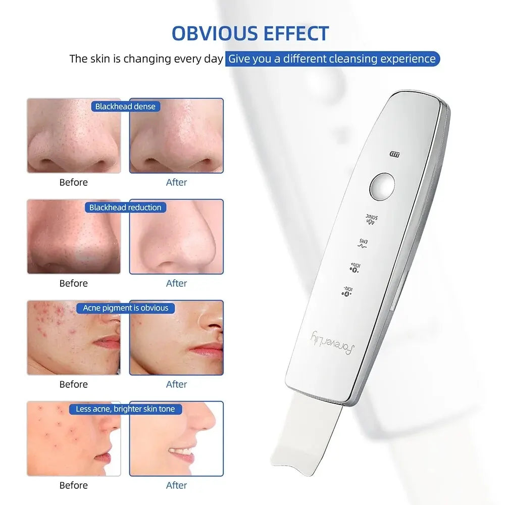 Ultrasonic Face Scrubber Beauty Red&Blue Light LED Photon Therapy EMS Facial Peeling Ion Pore Clean Remove Blackhead Exfoliation