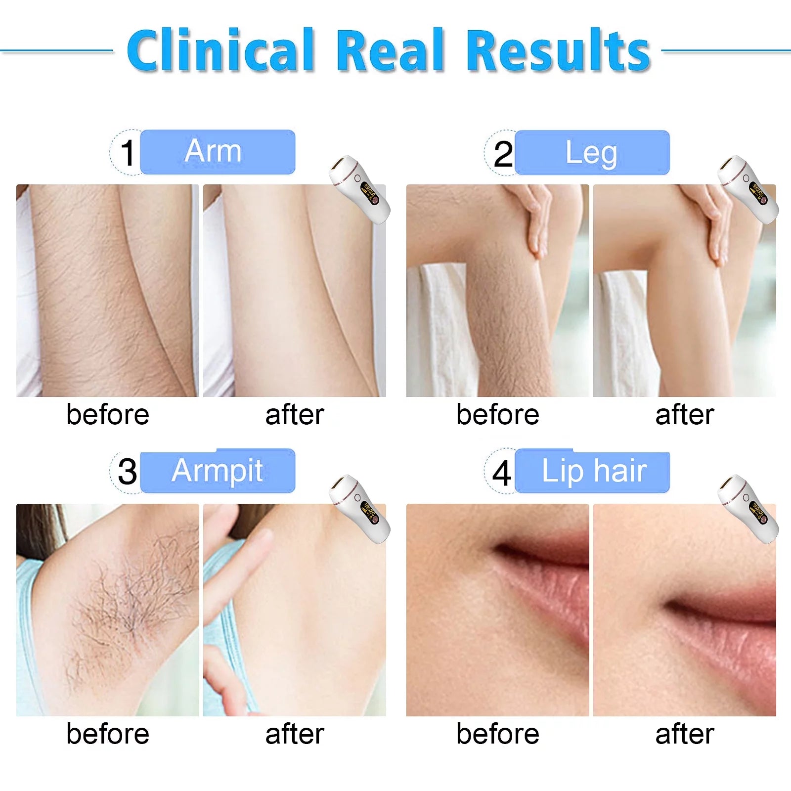 IPL Laser Hair Removal Device, 2-In-1Painless Hair Remover for Women and Men, 5 Modes with Razor & Goggles